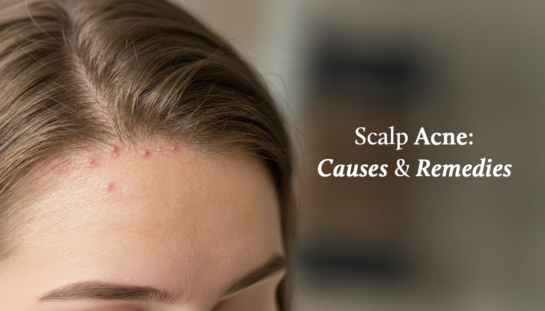 Scalp Acne Treatment: Causes, Ayurvedic Remedies, and Prevention Tips