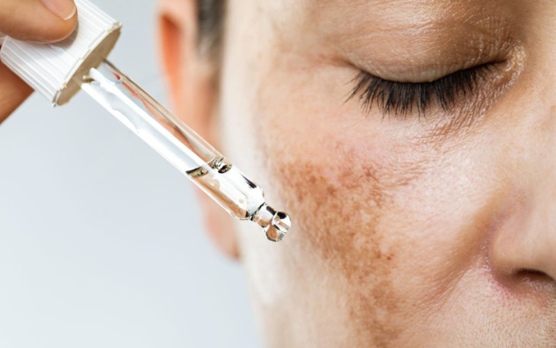 lady is applying vitamin c face serum on her dark spots 