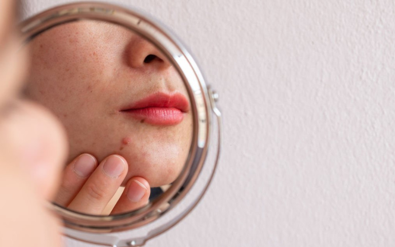 girl is worried and looking infront of mirror for her acne on chin 